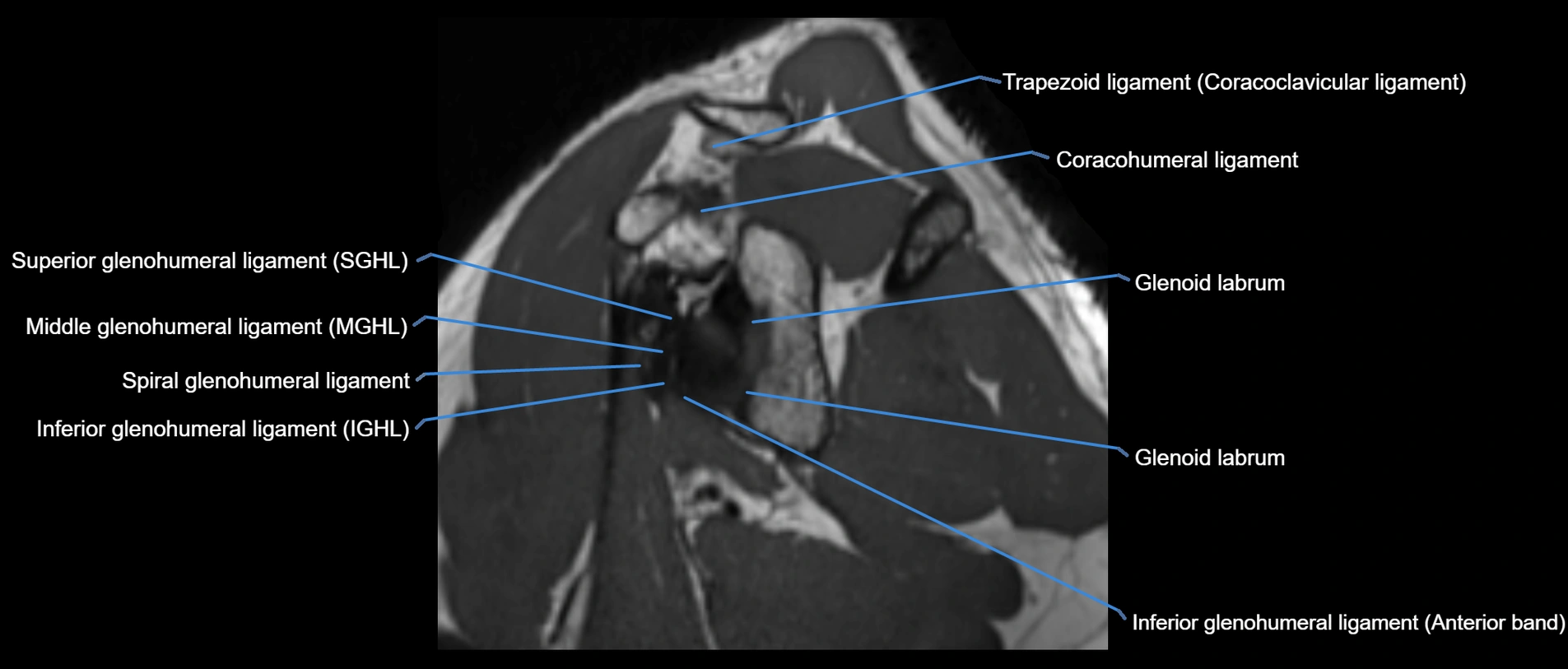 shoulder ligaments sagittal  cross sectional anatomy 3T MRI AI enhanced radiology image -img-00001-00024.webp